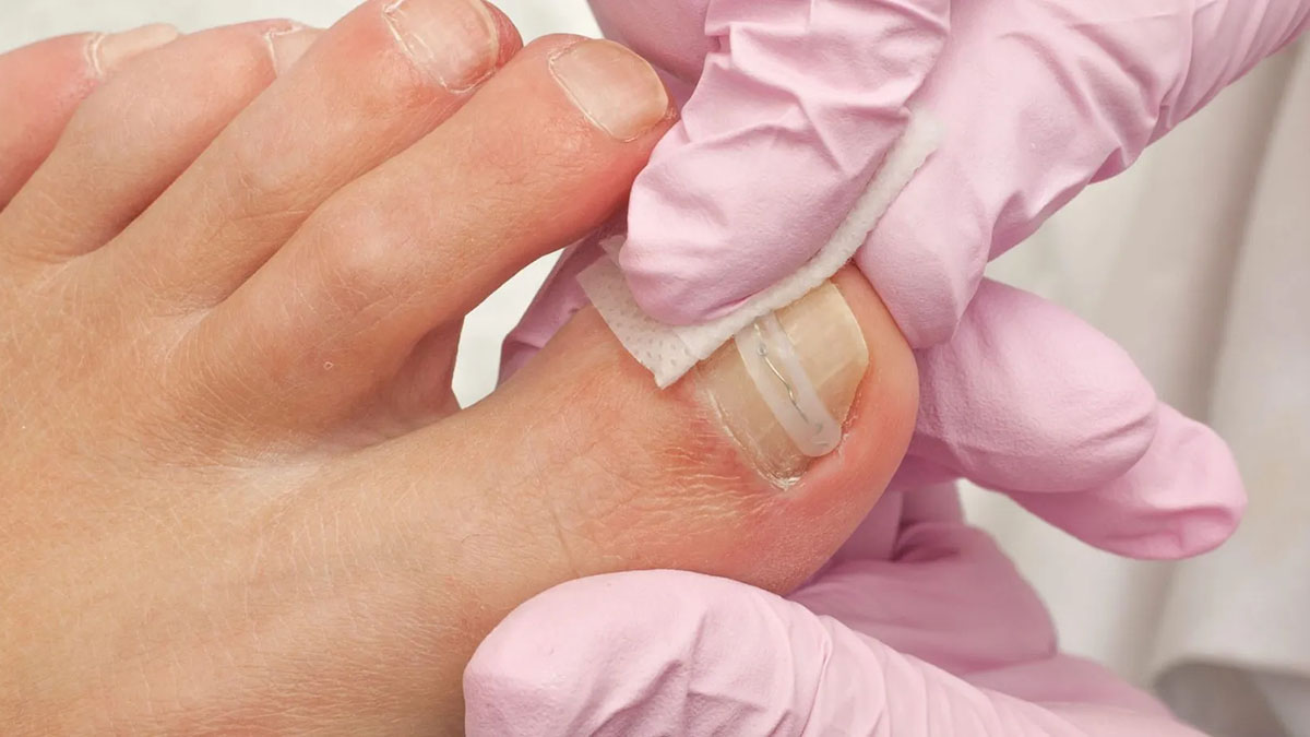 kadin-ayak-tirnak-tel-uygulamasi-tirnak-batmasi-bakimi